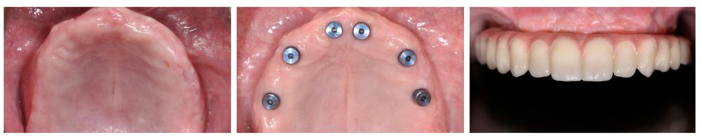 Proceso de ortopedia dentofacial ExcelDental